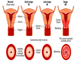 Cervical Cancer Screening (Package)